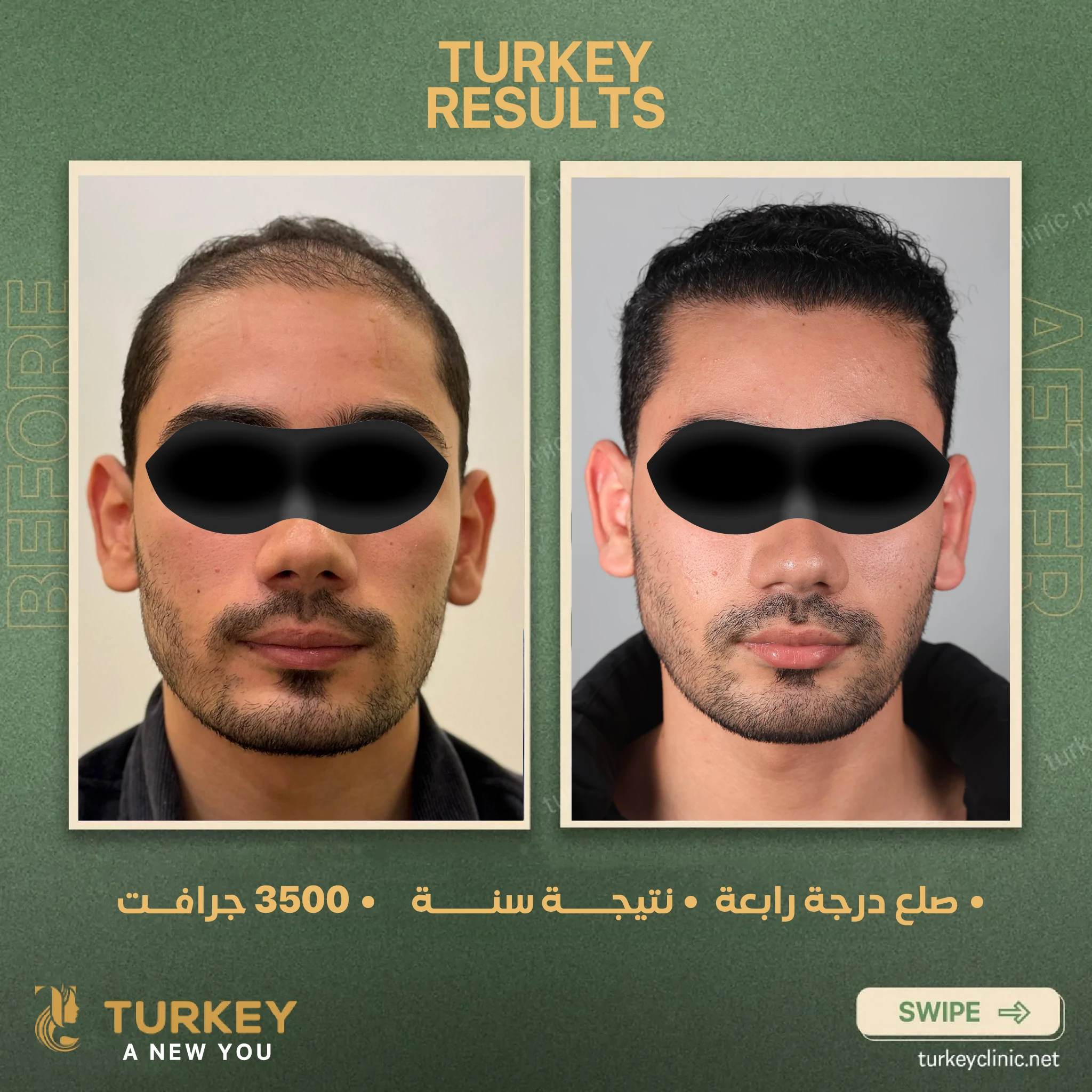 بعد ٢٠ يوم من زراعة الشعر | التغيرات المتوقعة وأهم التعليمات 5 صلع درجة رابعة نتيجة سنة 3500 جرافت