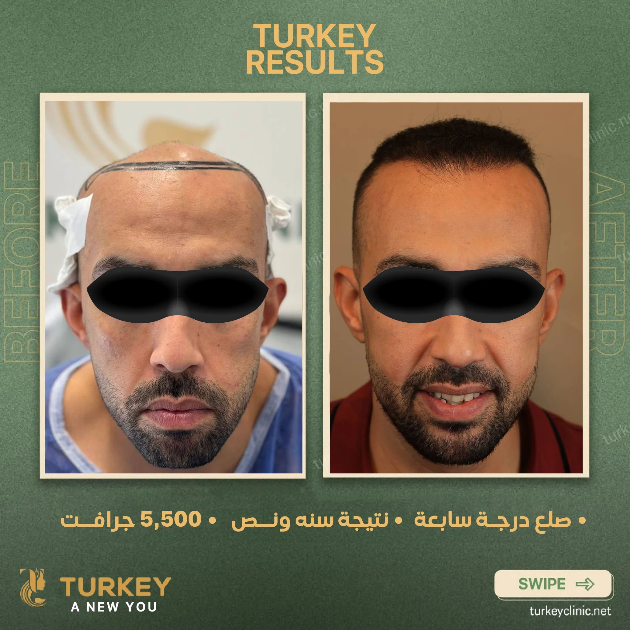 المينوكسيديل للشعر 5 فوائد مع النصائح بعد وقبل الأستخدام 8 صلع درجة سابعة نتيجة سنة ونص 5500 جرافت