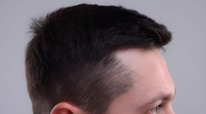 نتائج زراعة الشعر بعد 7 شهور