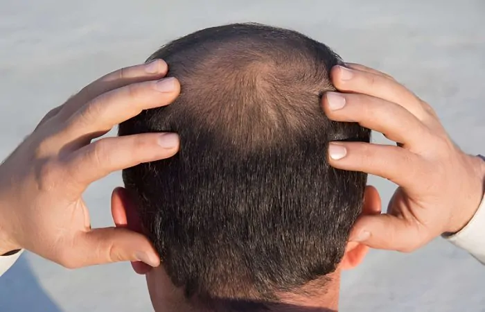 الصلع من الدرجة السادسة