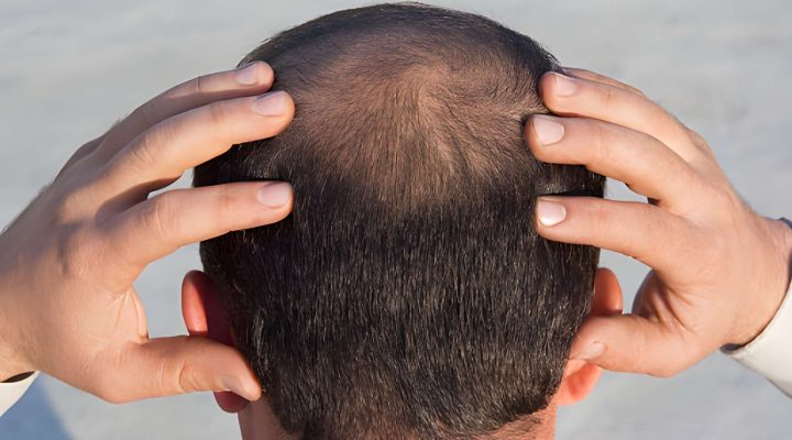 الصلع من الدرجة السادسة