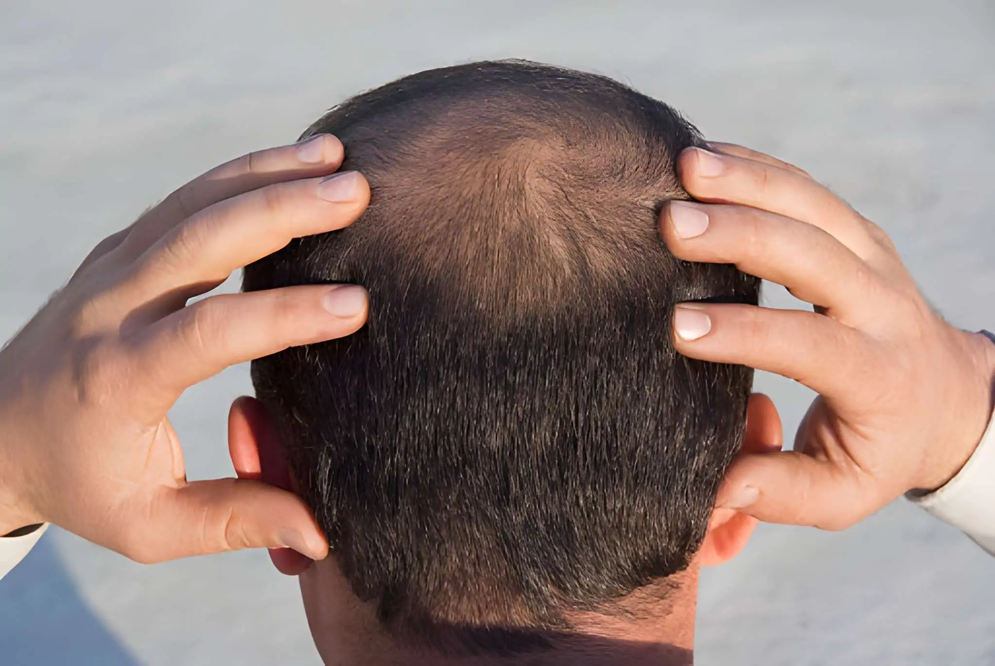 الصلع من الدرجة السادسة