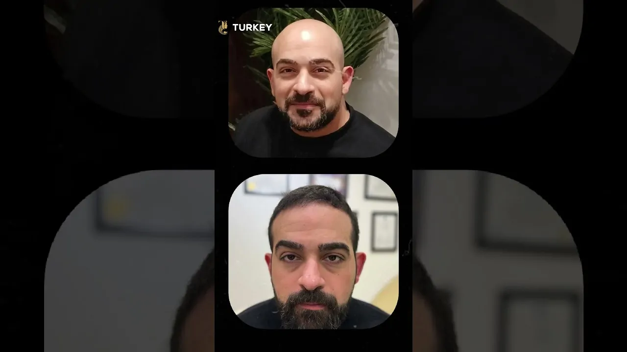 أسرار عملية زراعة الشعر الطبيعي