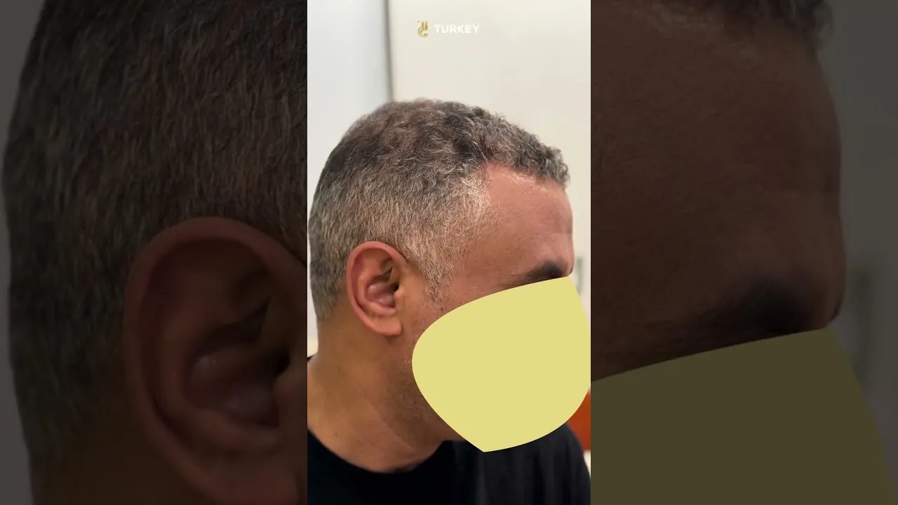 إمكانية زراعة الشعر الشائب