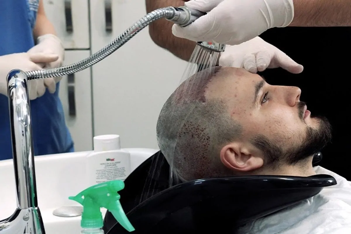 بعد ٢٠ يوم من زراعة الشعر | التغيرات المتوقعة وأهم التعليمات 3 التغيرات المتوقعة بعد ٢٠ يوم من زراعة الشعر