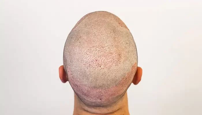 بعد ٢٠ يوم من زراعة الشعر