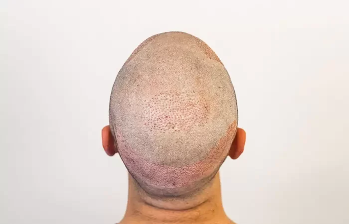 بعد ٢٠ يوم من زراعة الشعر