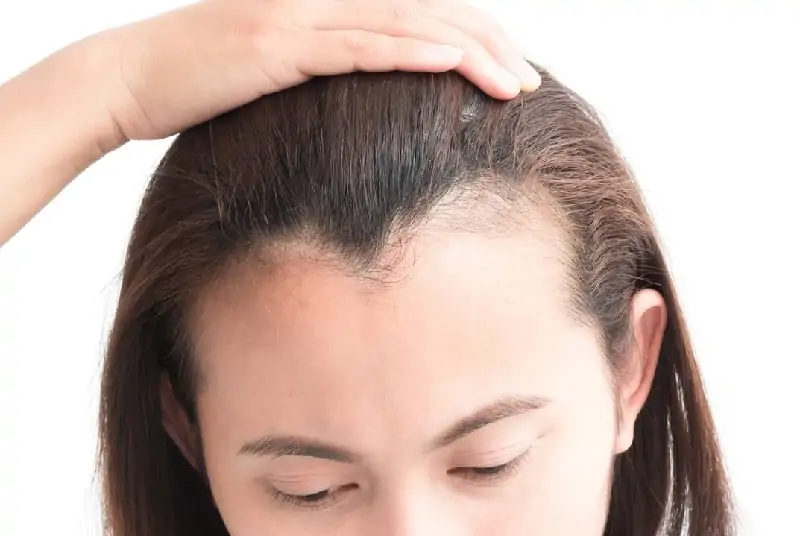 خط الشعر المثالي للجبهه للنساء والرجال لزراعة شعر مميزة 2 ما هو خط الشعر المثالي؟