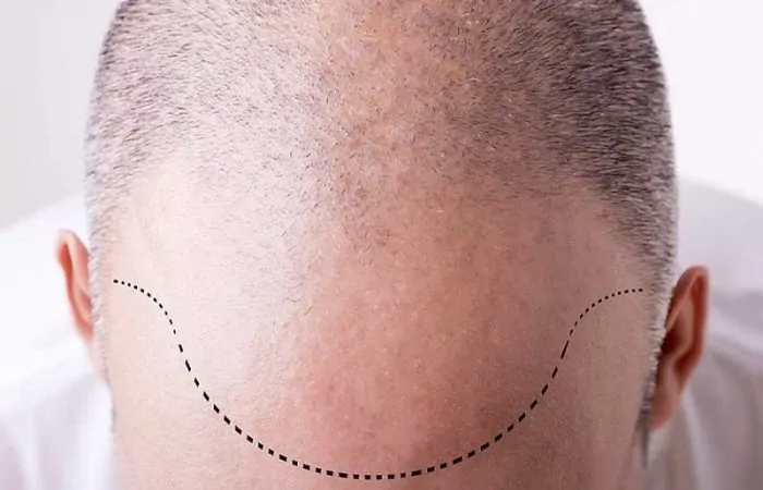 خط الشعر المثالي