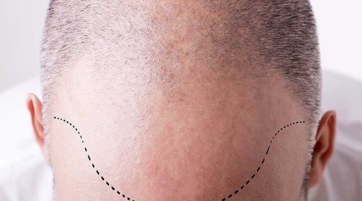 خط الشعر المثالي