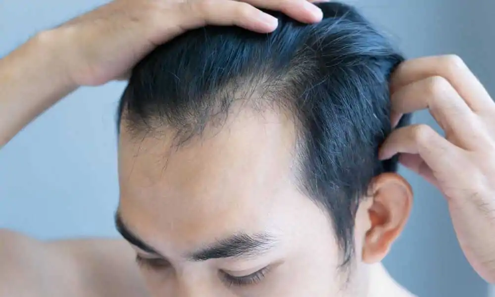 خط الشعر المثالي للجبهه للنساء والرجال لزراعة شعر مميزة 4 علاج تراجع خط الشعر ودور الزراعة في تحقيق خط مثالي