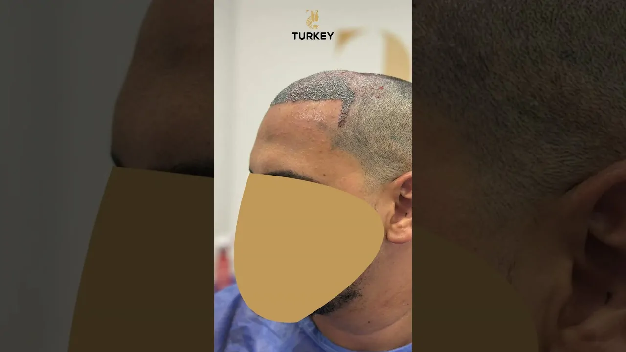 زراعة الشعر قبل وبعد في تركي هير كلينك