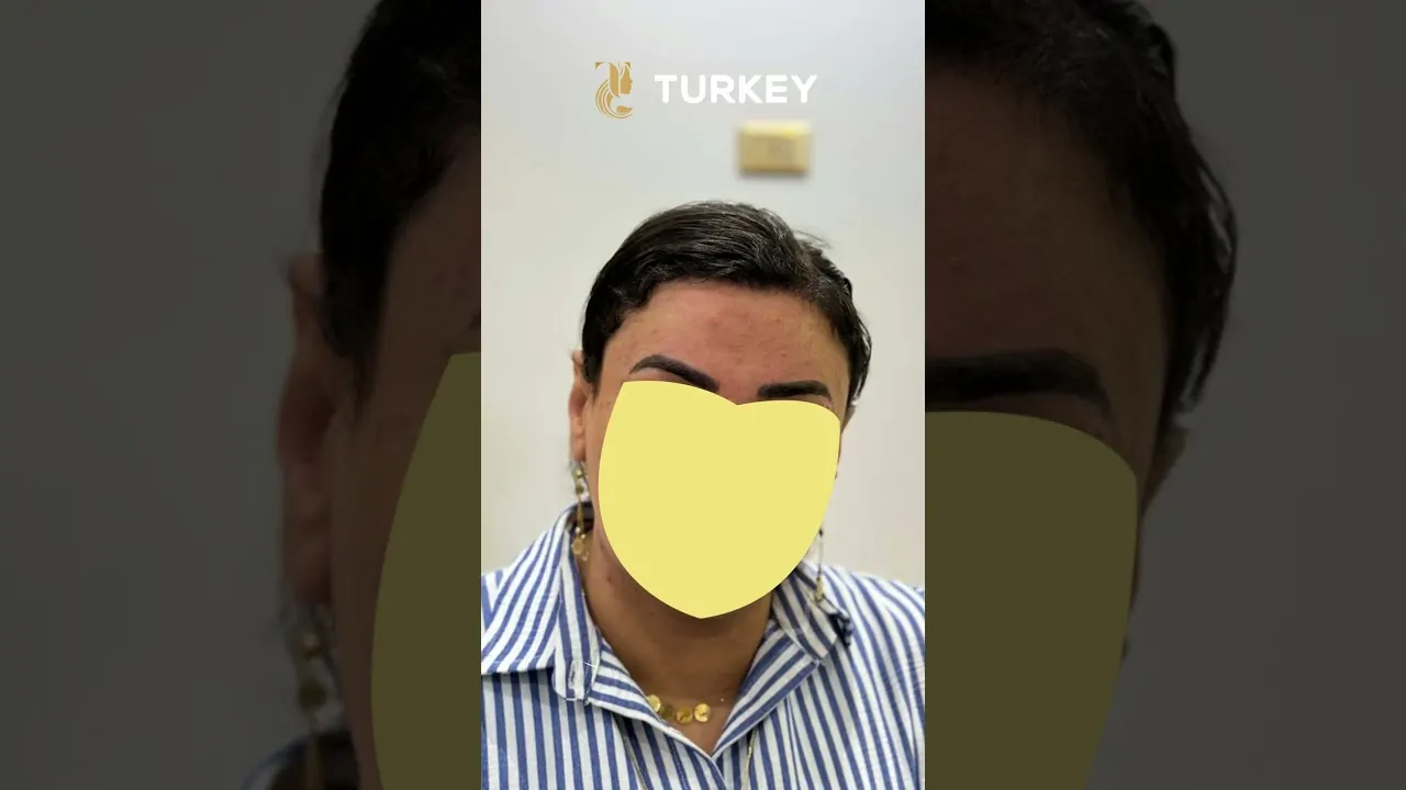 زراعة الشعر للنساء لجبهة أصغر