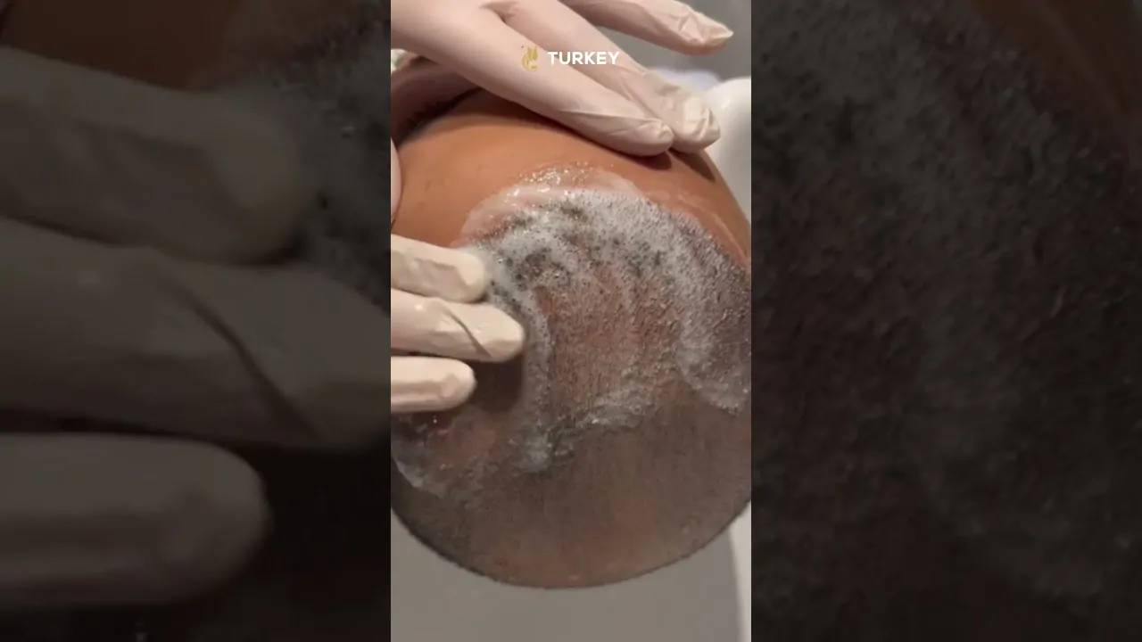 طريقة غسل الشعر المزروع