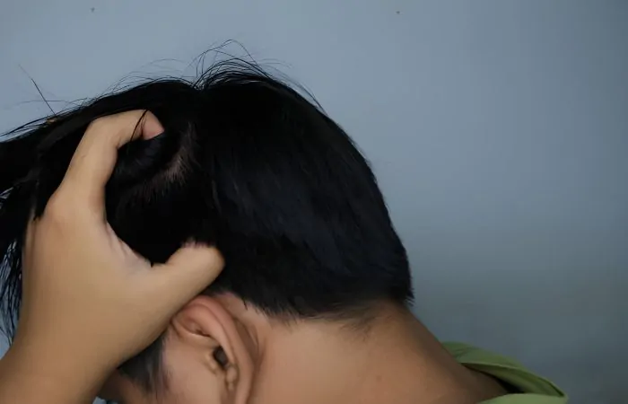 عدم تساقط الشعر المزروع