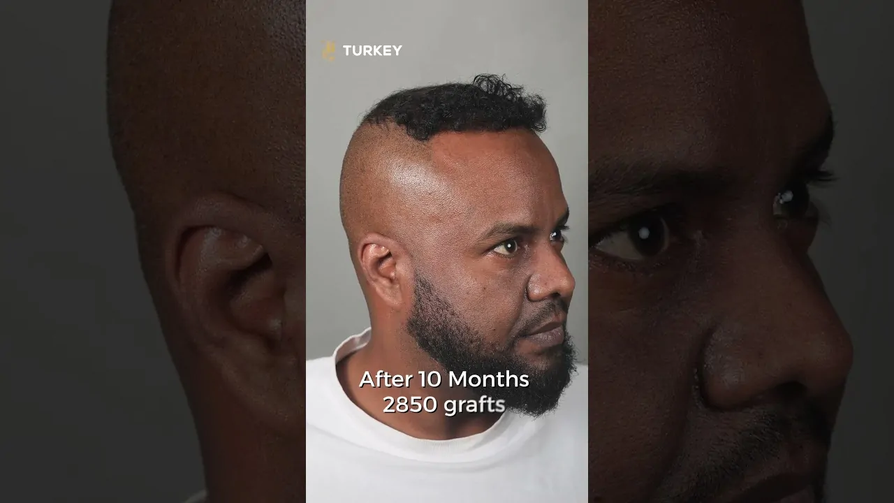 نتيجة زراعة الشعر الأفرو بعد 10 شهور