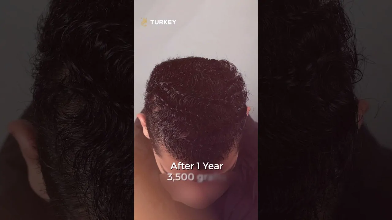نتيجة زراعة شعر بعد سنة لدرجة صلع رابعة