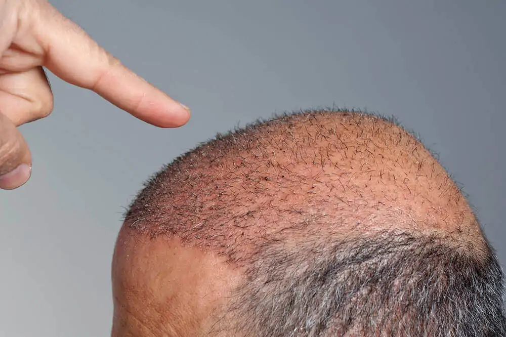 نصائح قبل وبعد عملية زراعة الشعر مع أهم التعليمات 2 هل أنت مرشح مثالي لزراعة الشعر؟