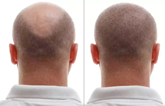نصائح قبل وبعد عملية زراعة الشعر57