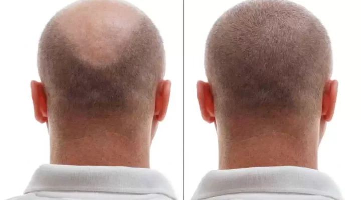 نصائح قبل وبعد عملية زراعة الشعر57
