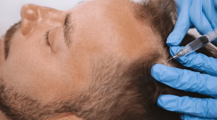 هل زراعة الشعر مؤلمة