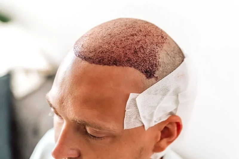 هل زراعة الشعر مؤلمة؟ مع 7 نصائح للحد من آثار التخدير 4 هل يمكن إجراء زراعة الشعر بدون تخدير؟