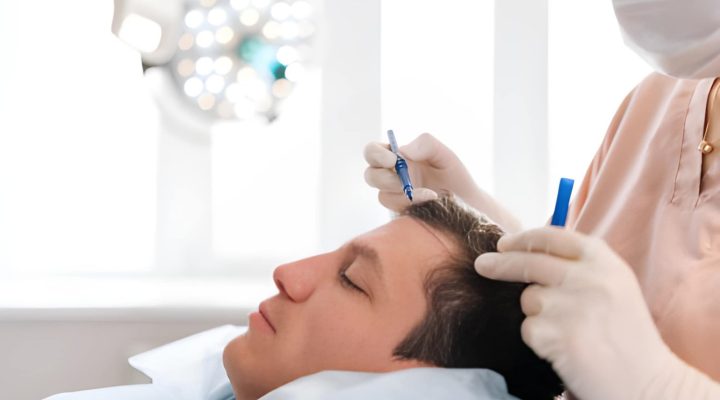 أخطاء في زراعة الشعر