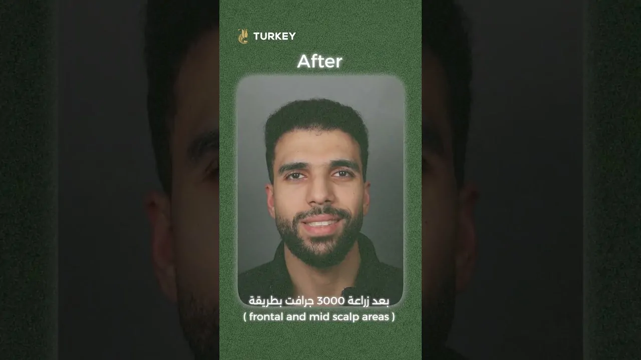 إصلاح عملية زراعة شعر فاشلة