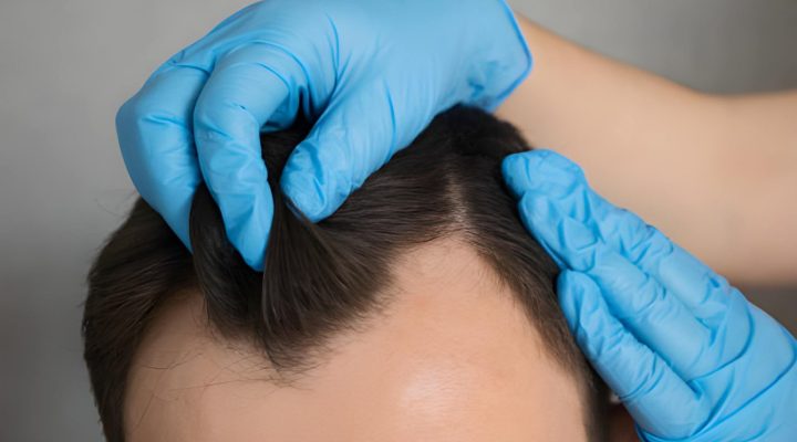 زاوية زراعة الشعر