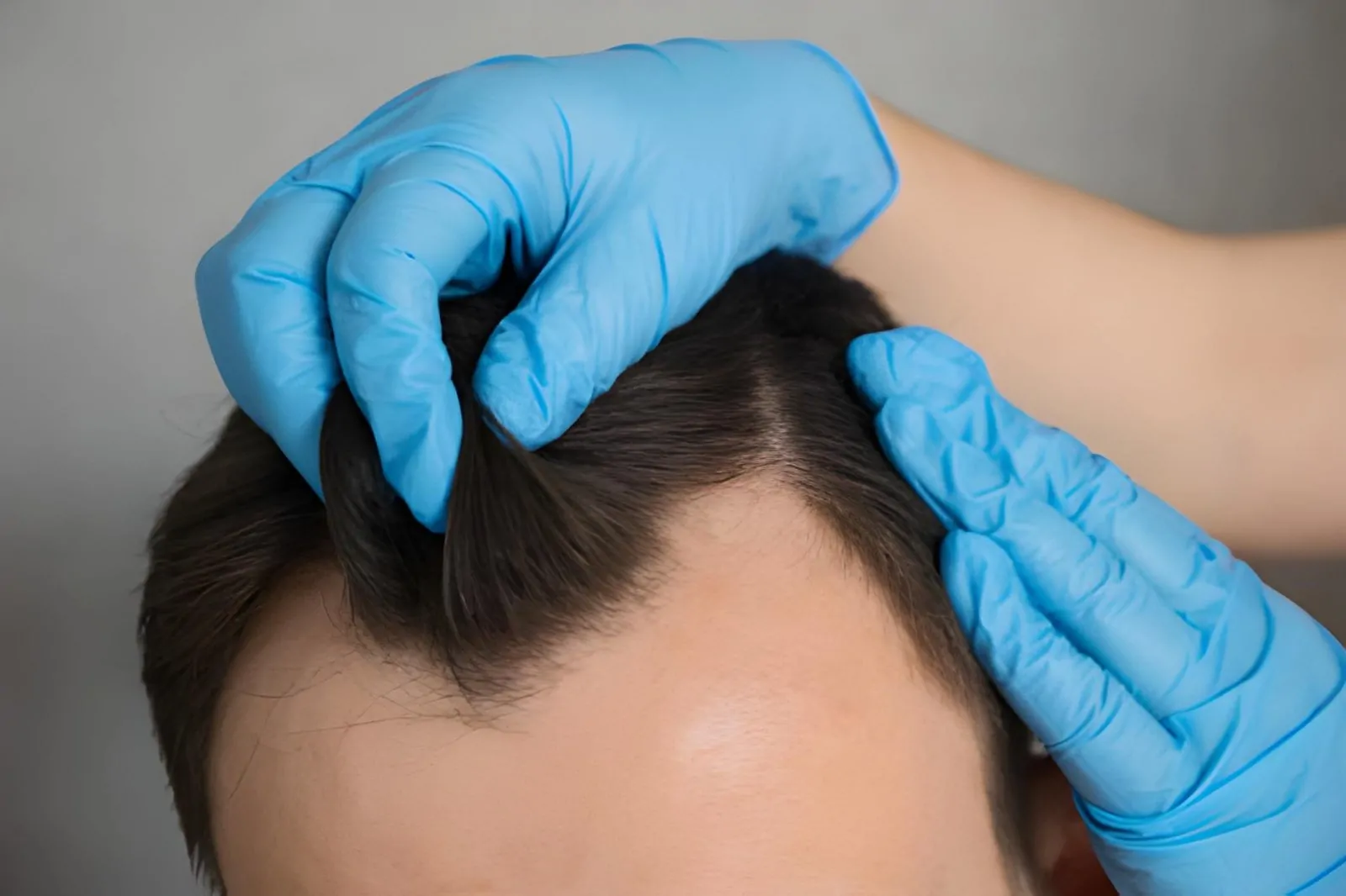 زاوية زراعة الشعر