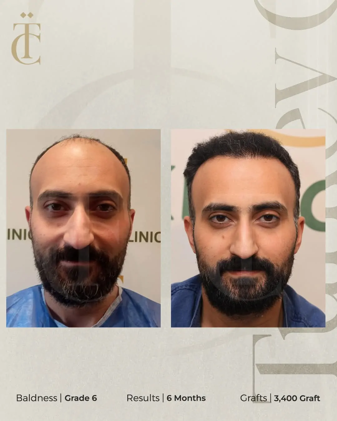 عملية زراعة الشعر قبل وبعد