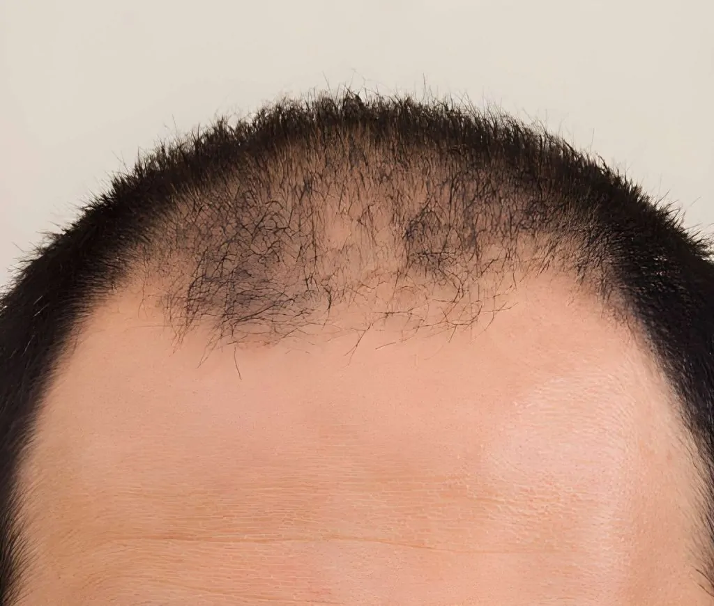 فراغات الشعر من الجوانب للرجال: الأسباب والحلول النهائية 2 فراغات الشعر من الجوانب للرجال
