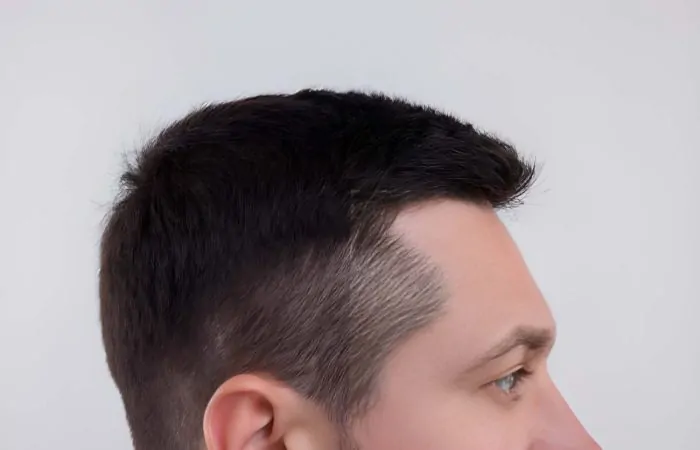 فراغات الشعر من الجوانب للرجال: الأسباب والحلول النهائية 3 فراغات الشعر من الجوانب للرجال