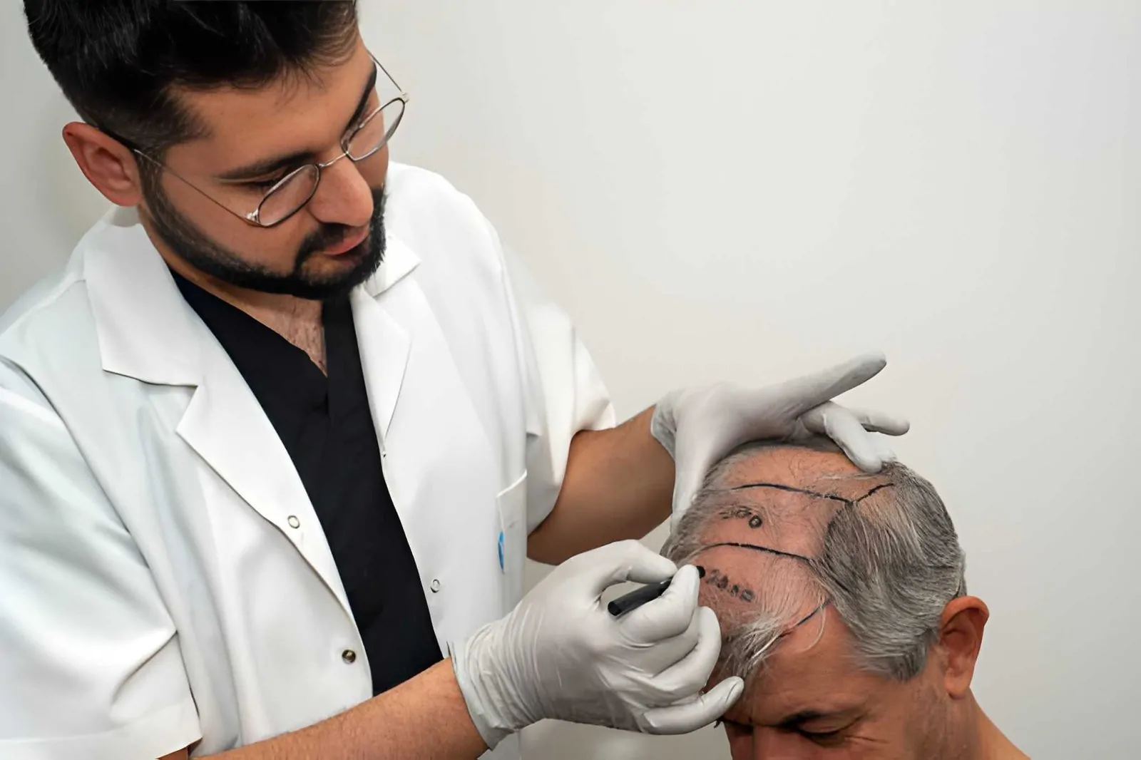 لون الشعر الأبيض بعد الزراعة