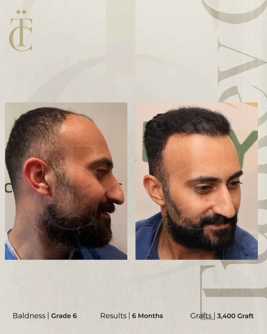 نتائج زراعة الشعر في مصر