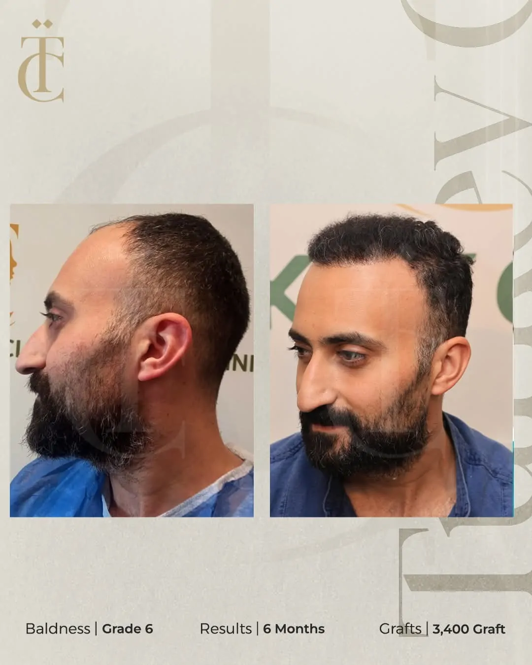نتائج زراعة الشعر قبل وبعد