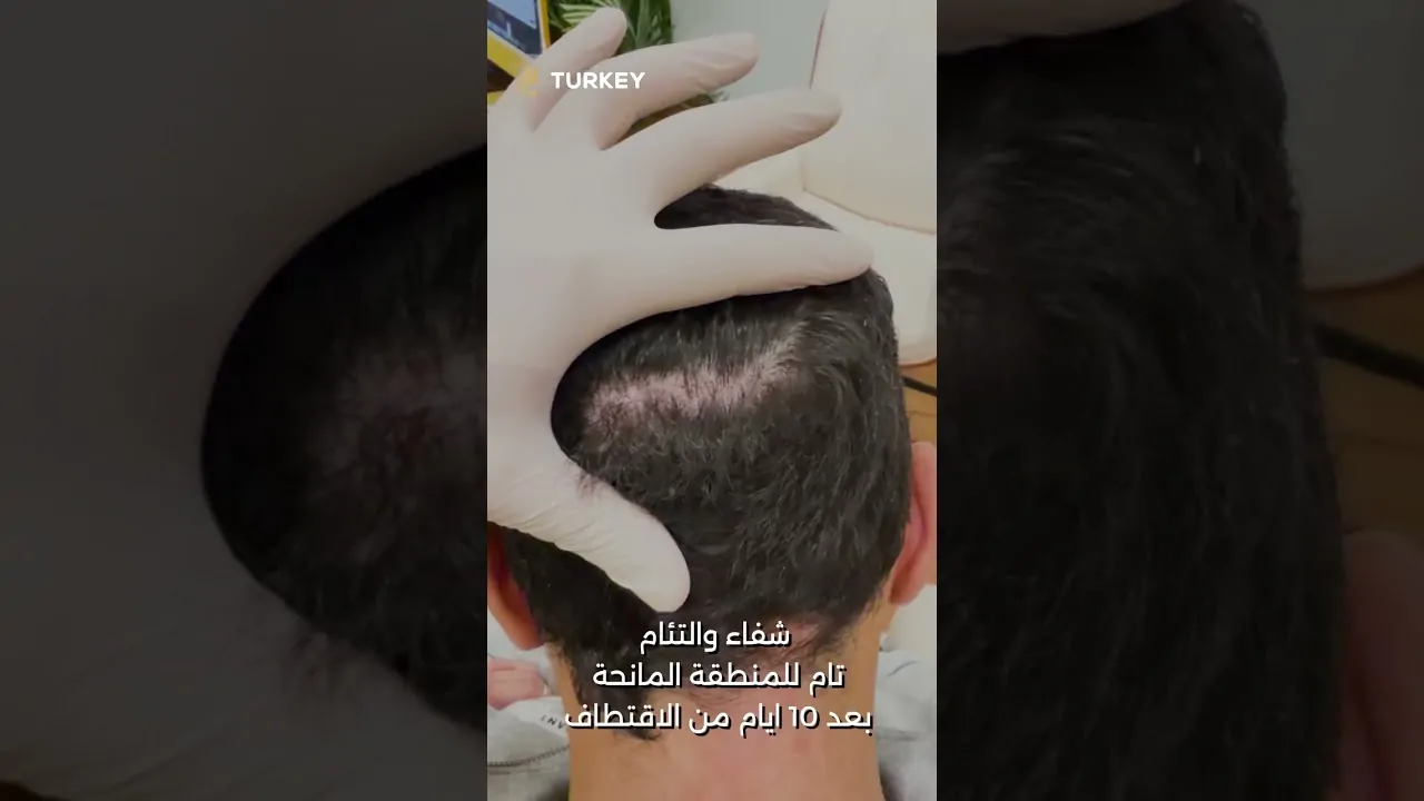 نتيجة زراعة الشعر بدون حلاقة بعد 10 أيام