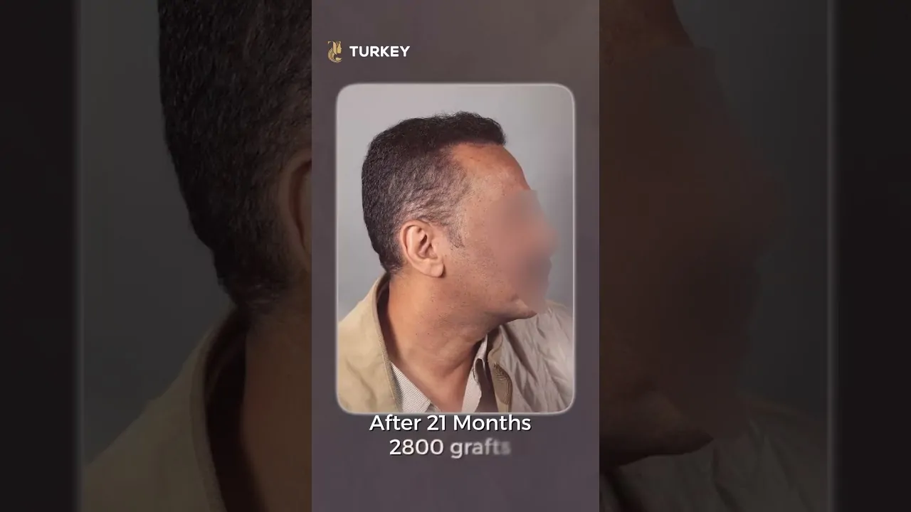 نتيجة زراعة الشعر بعد 21 شهر | 2800 جرافت