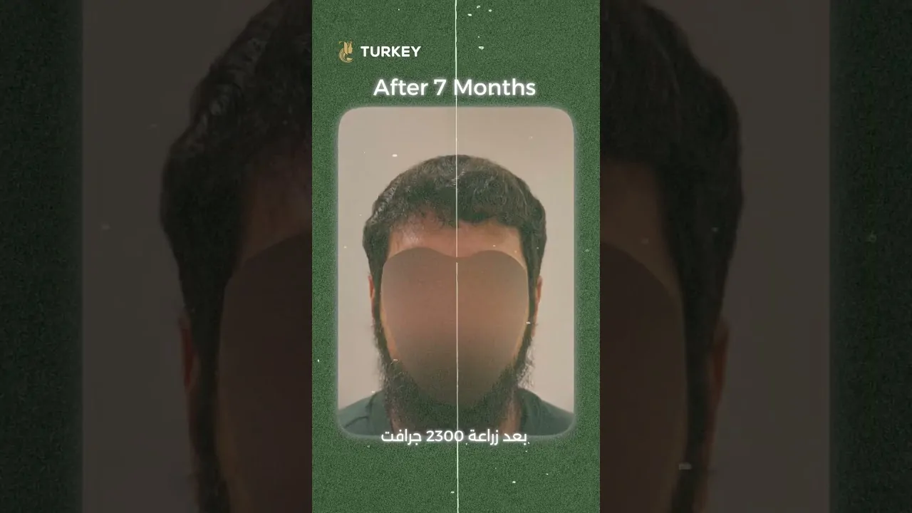 نتيجة زراعة الشعر بعد 7 شهور