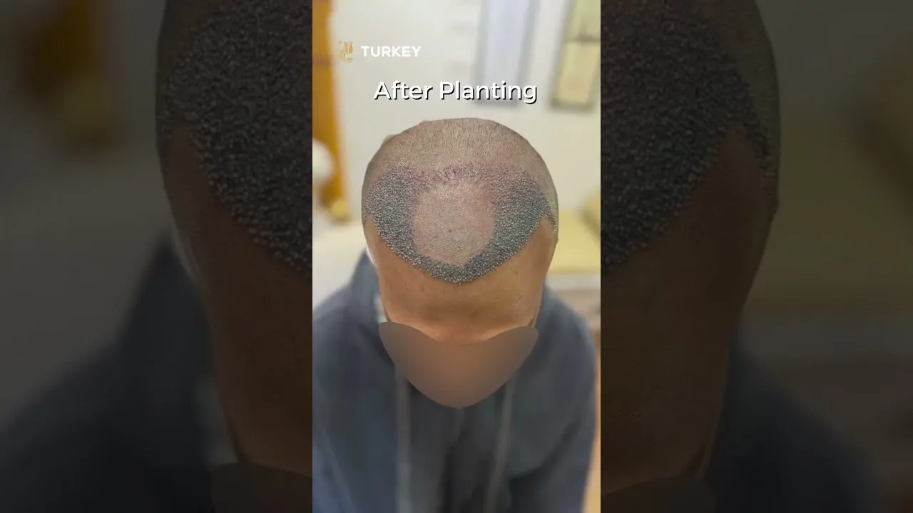 نتيجة زراعة الشعر بعد 8 شهور