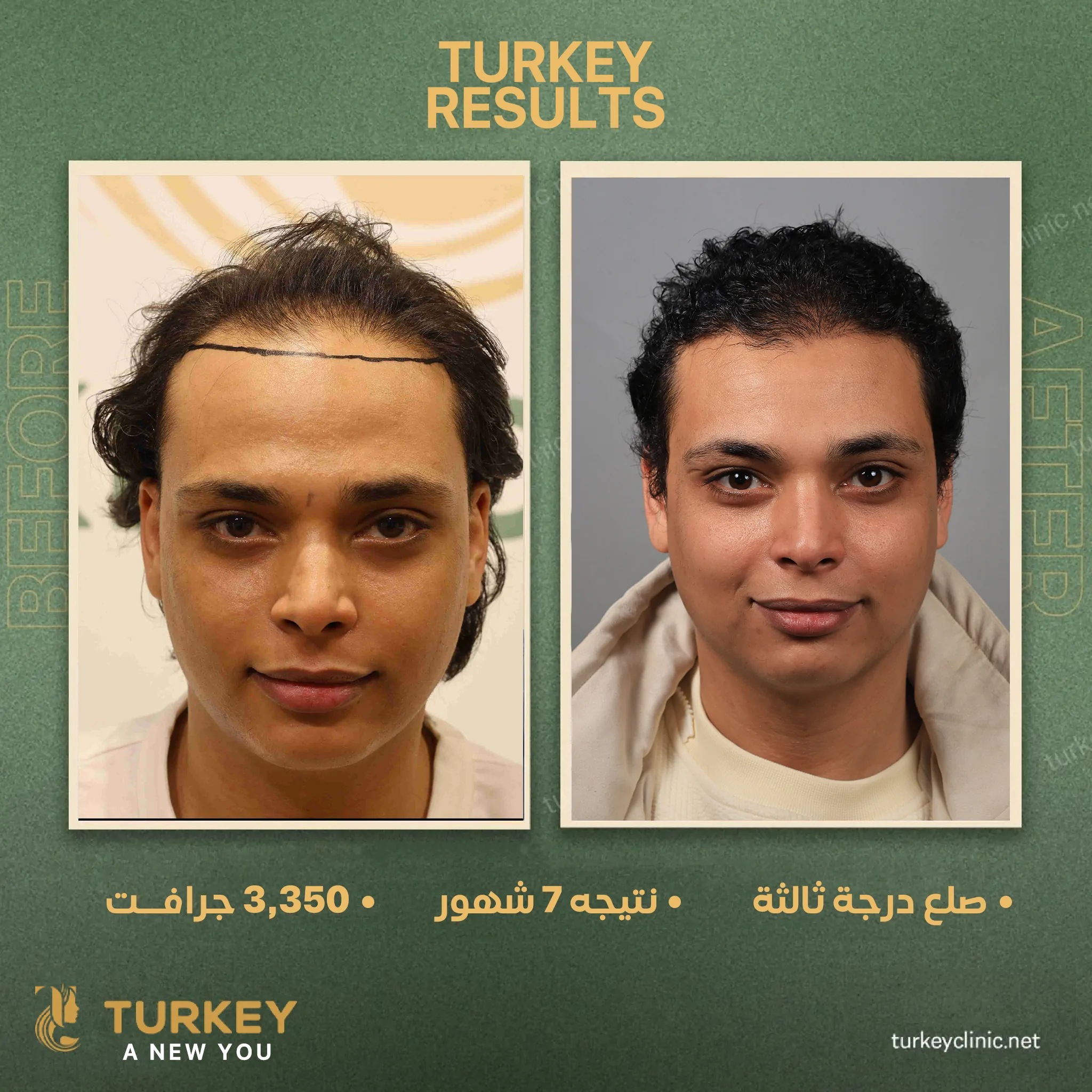 جهاز الاقتطاف الأمريكي Zeus: وداعاً لتلف البصيلات 6 نتائج زراعة الشعر 3350 جرافت قبل وبعد
