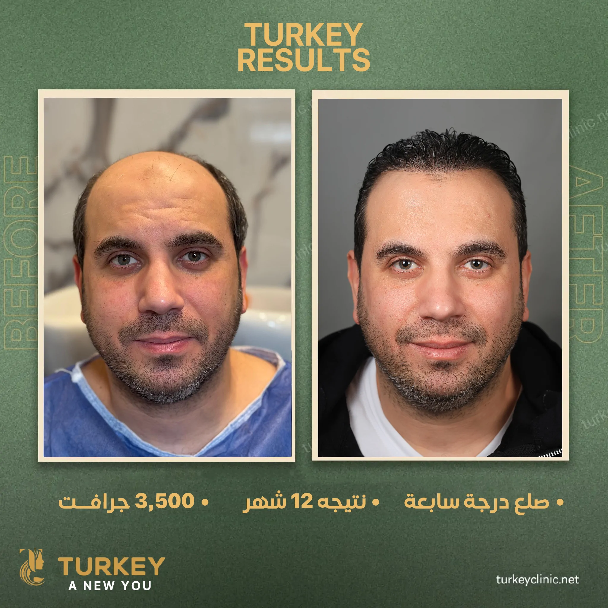جهاز الاقتطاف الأمريكي Zeus: وداعاً لتلف البصيلات 5 نتائج زراعة الشعر 3500 جرافت
