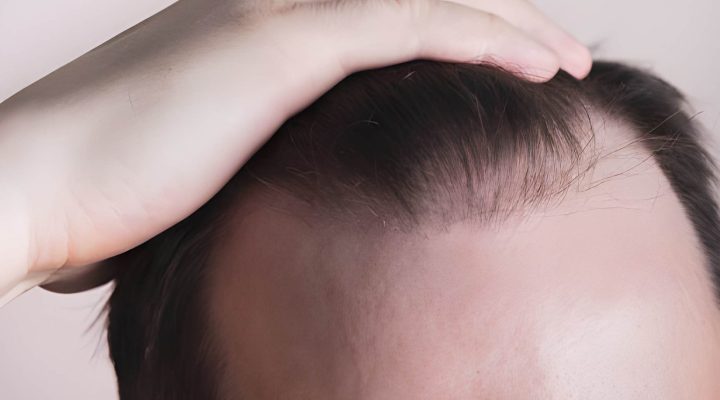 الفيناسترايد لعلاج الصلع