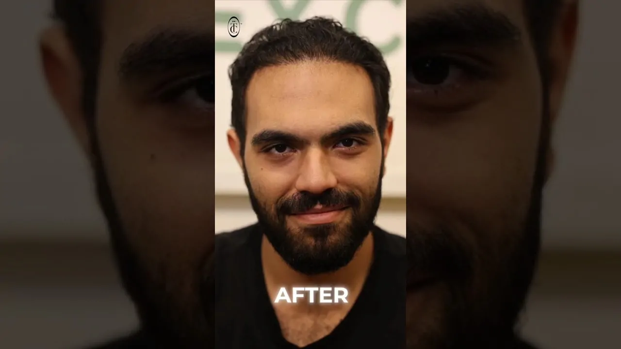 الفرق قبل وبعد زراعة الشعر