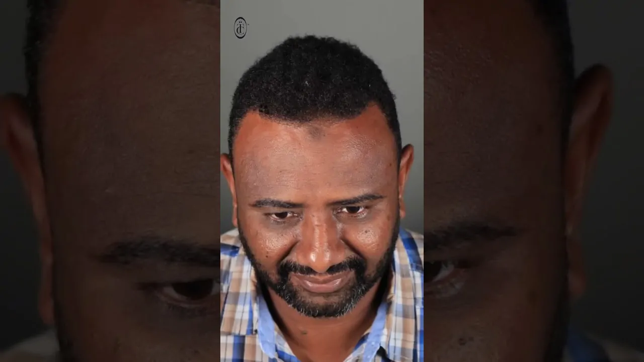 زراعة الشعر للصلع من الدرجة الخامسة