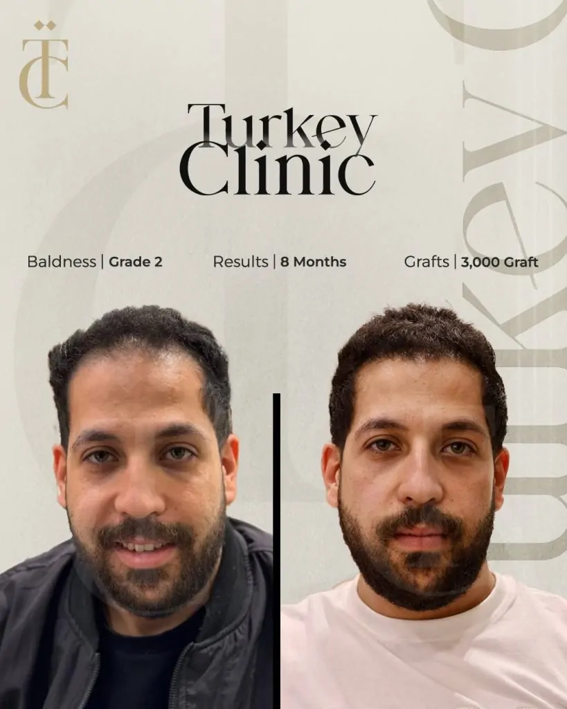 زراعة الشعر للصلع الوراثي الدرجة الثانية بعد 8 أشهر 3000 بصيلة