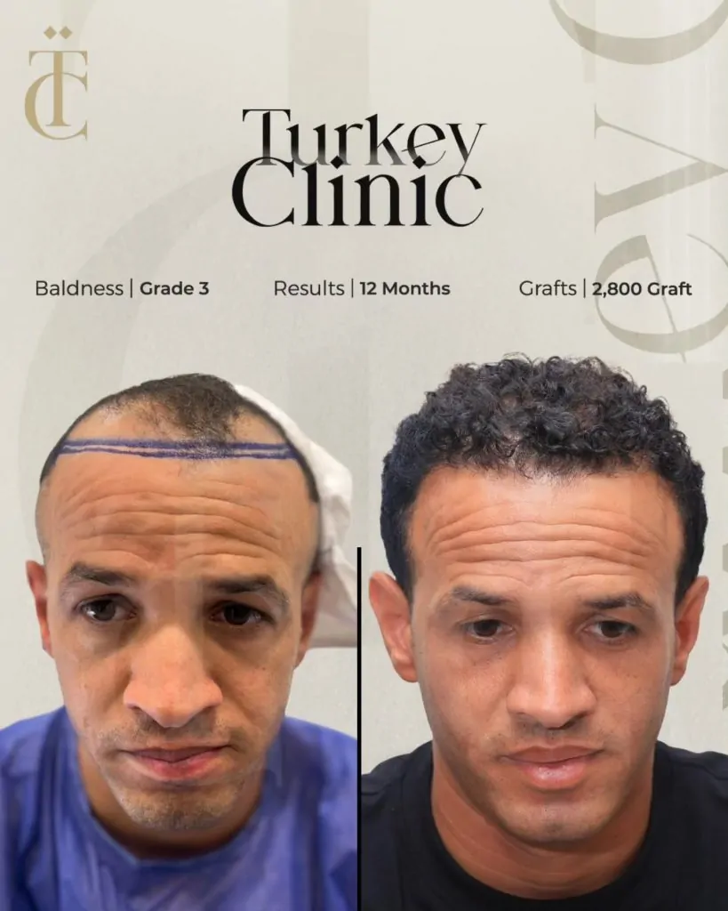 نتائج زراعة الشعر للصلع الوراثي الدرجة الثالثة بعد 12 شهرًا 2800 بصيلة