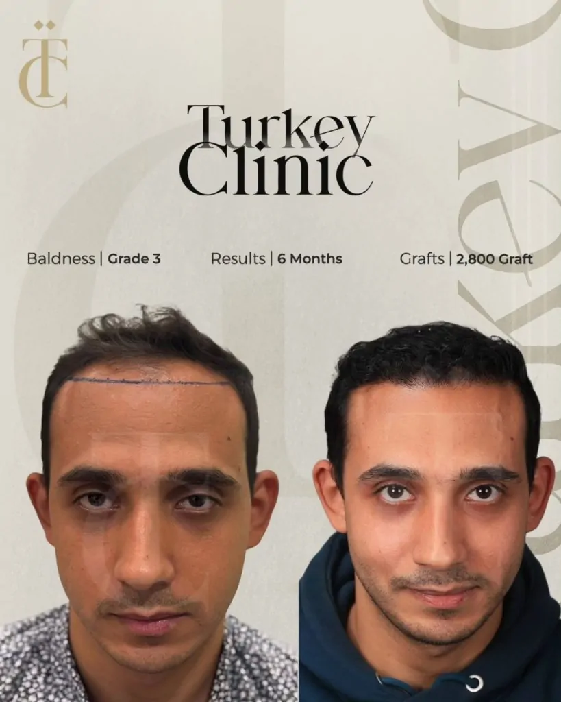 نتائج زراعة الشعر للصلع الوراثي الدرجة الثالثة بعد 6 أشهر 2800 بصيلة