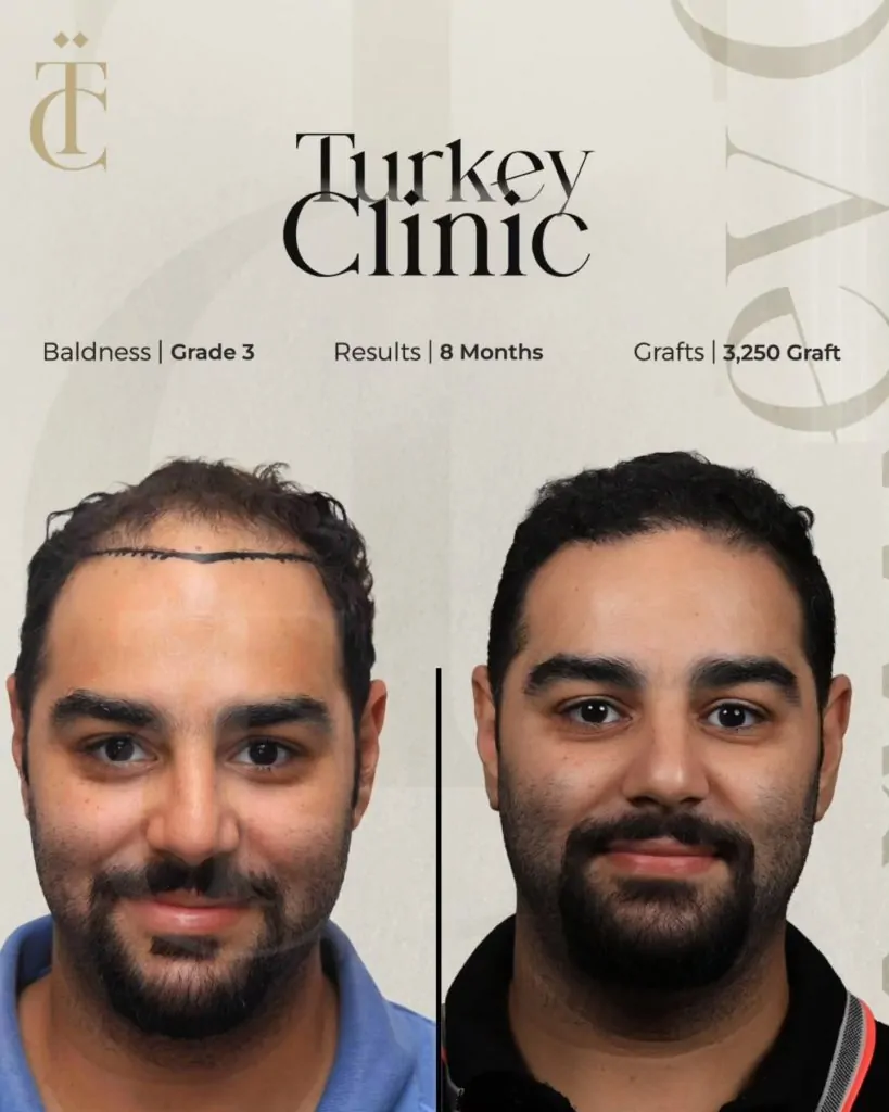 نتائج زراعة الشعر للصلع الوراثي الدرجة الثالثة بعد 8 أشهر 3250 بصيلة