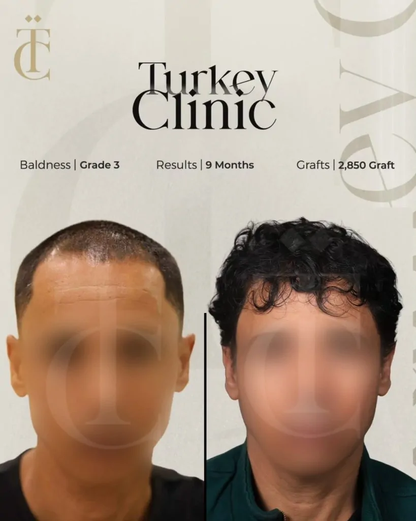 نتائج زراعة الشعر للصلع الوراثي الدرجة الثالثة بعد 9 أشهر 2850 بصيلة